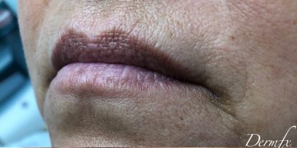 Juvederm Ultra Before & After Patient #1599