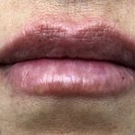 Juvederm Ultra Before & After Patient #1599