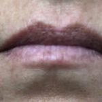 Juvederm Ultra Before & After Patient #1599