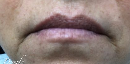 Juvederm Ultra Before & After Patient #1599