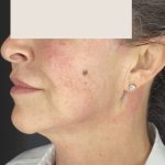 Thread Lift Before & After Patient #1534