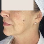 Thread Lift Before & After Patient #1534
