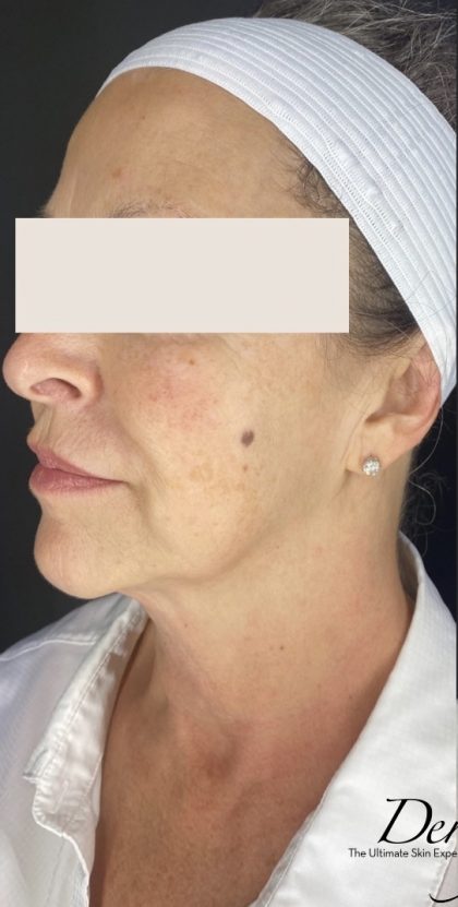 Thread Lift Before & After Patient #1534