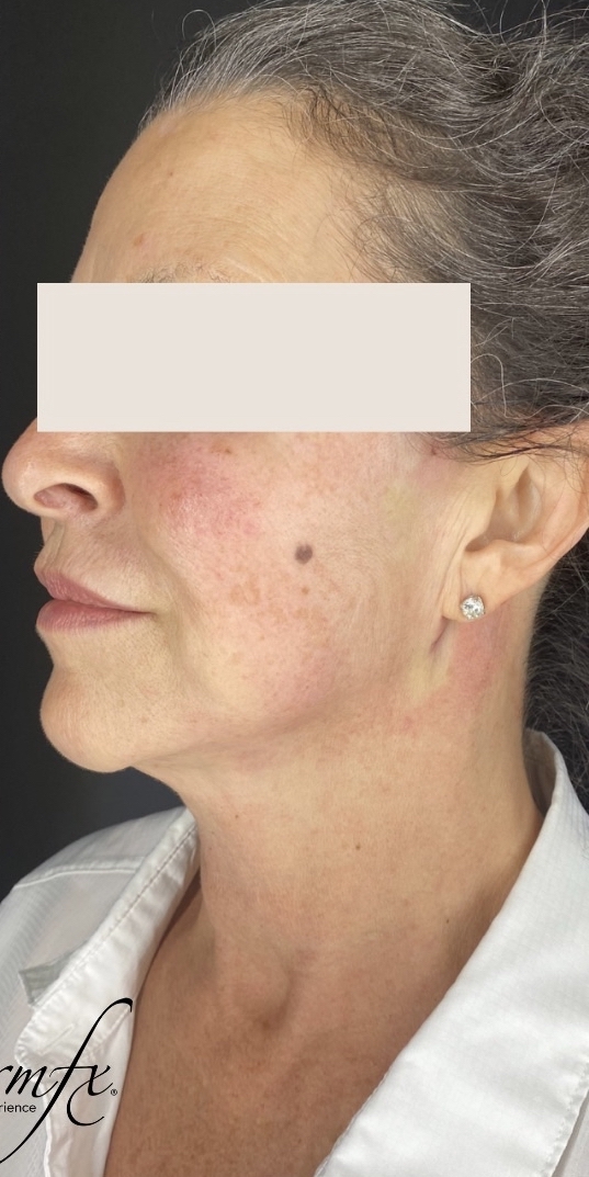 Thread Lift Before & After Patient #1534