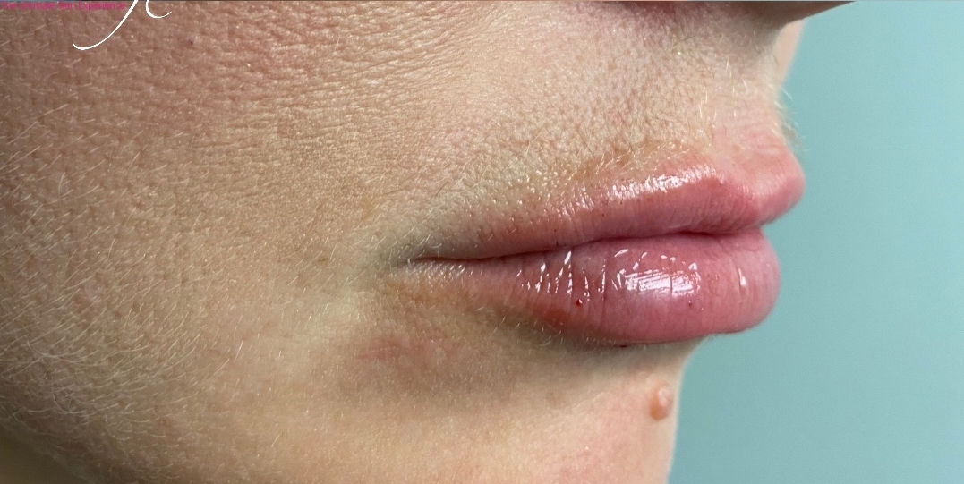 Restylane Before & After Patient #1640