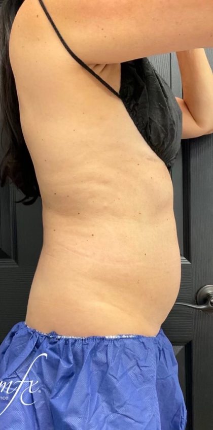 CoolSculpting Before & After Patient #1573