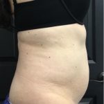 CoolSculpting Before & After Patient #1573