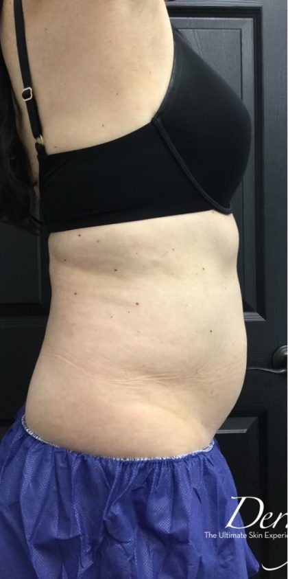 CoolSculpting Before & After Patient #1573