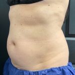 CoolSculpting Before & After Patient #1573