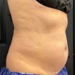 CoolSculpting Before & After Patient #1573