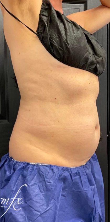 CoolSculpting Before & After Patient #1573