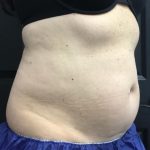 CoolSculpting Before & After Patient #1573