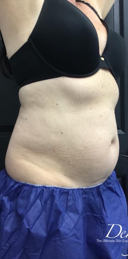CoolSculpting Before & After Patient #1573