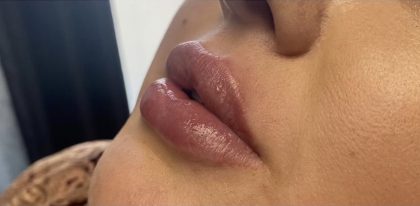 Juvederm Before & After Patient #1549