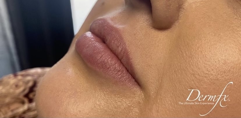 Juvederm Before & After Patient #1549