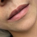 Restylane Before & After Patient #1643
