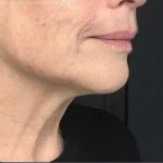 Radiesse Before & After Patient #1495