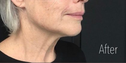 Radiesse Before & After Patient #1495