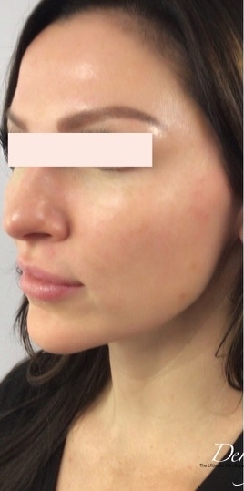 Radiesse Before & After Patient #1500