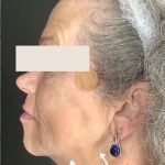 Thread Lift Before & After Patient #1543