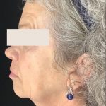 Thread Lift Before & After Patient #1543