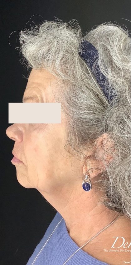 Thread Lift Before & After Patient #1543