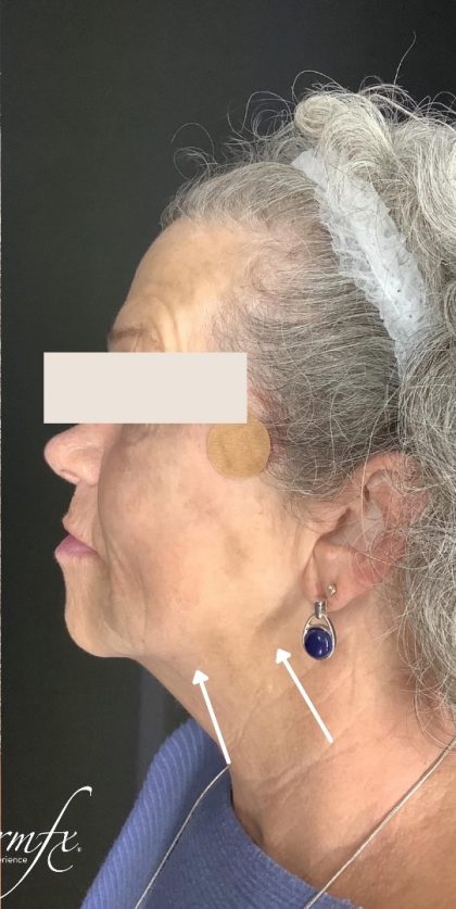 Thread Lift Before & After Patient #1543