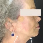 Thread Lift Before & After Patient #1543