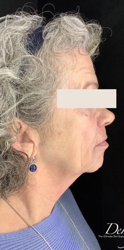 Thread Lift Before & After Patient #1543