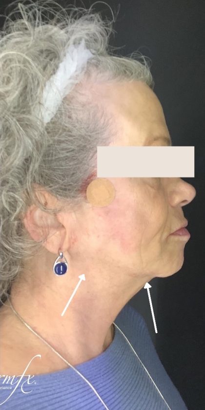 Thread Lift Before & After Patient #1543