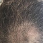 PRF Hair Restoration Before & After Patient #1474