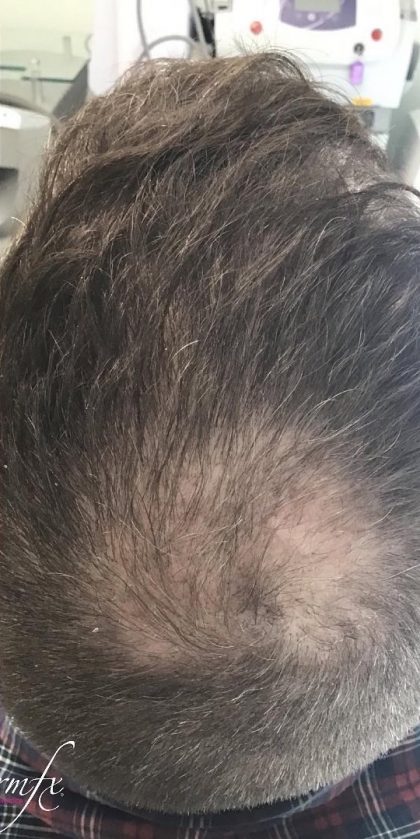 PRF Hair Restoration Before & After Patient #1474