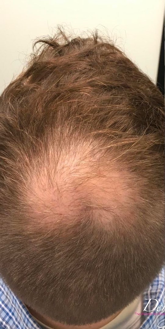 PRF Hair Restoration Before & After Patient #1474