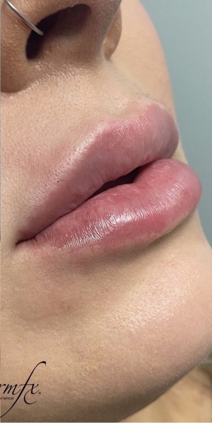 Juvederm Before & After Patient #1552
