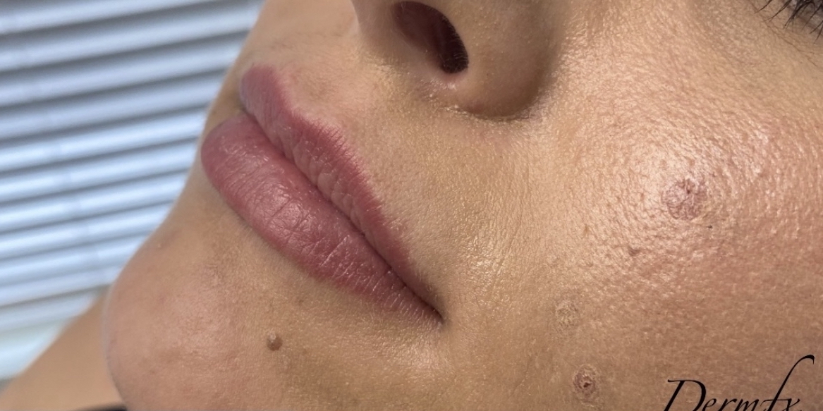 Voluma Before & After Patient #1555