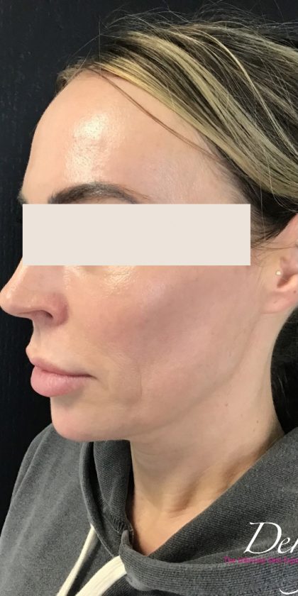 Thread Lift Before & After Patient #1537