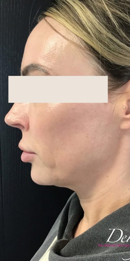 Thread Lift Before & After Patient #1537