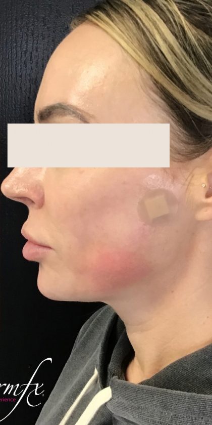 Thread Lift Before & After Patient #1537