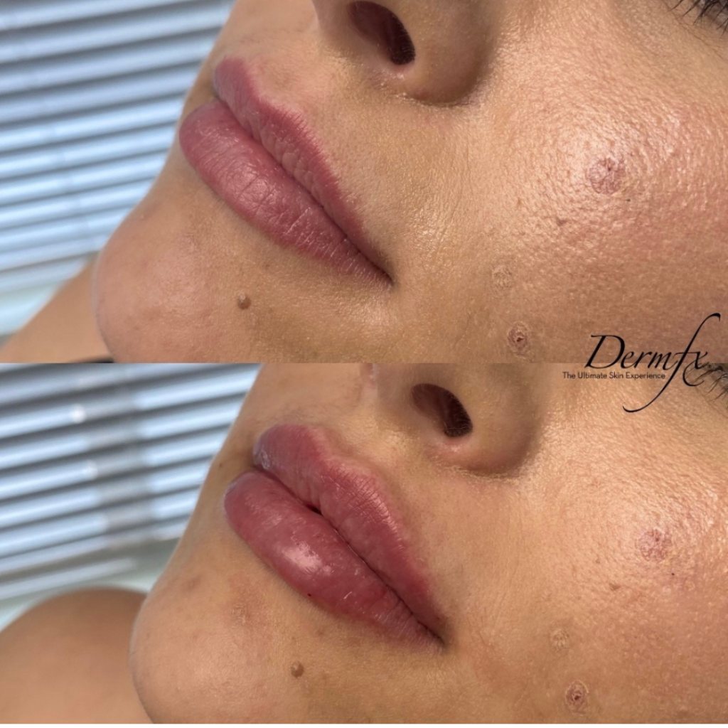 Dermal Fillers