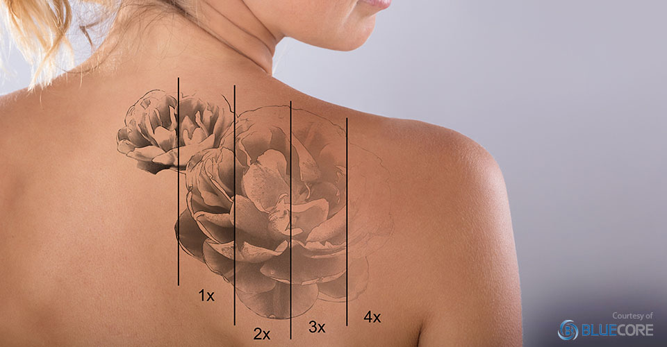 Tattoo Removal Brentwood  NdYAG Laser