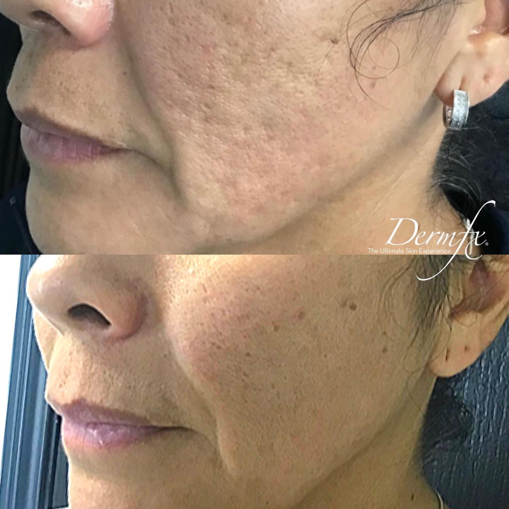 Dermfx Cosmetic Treatments