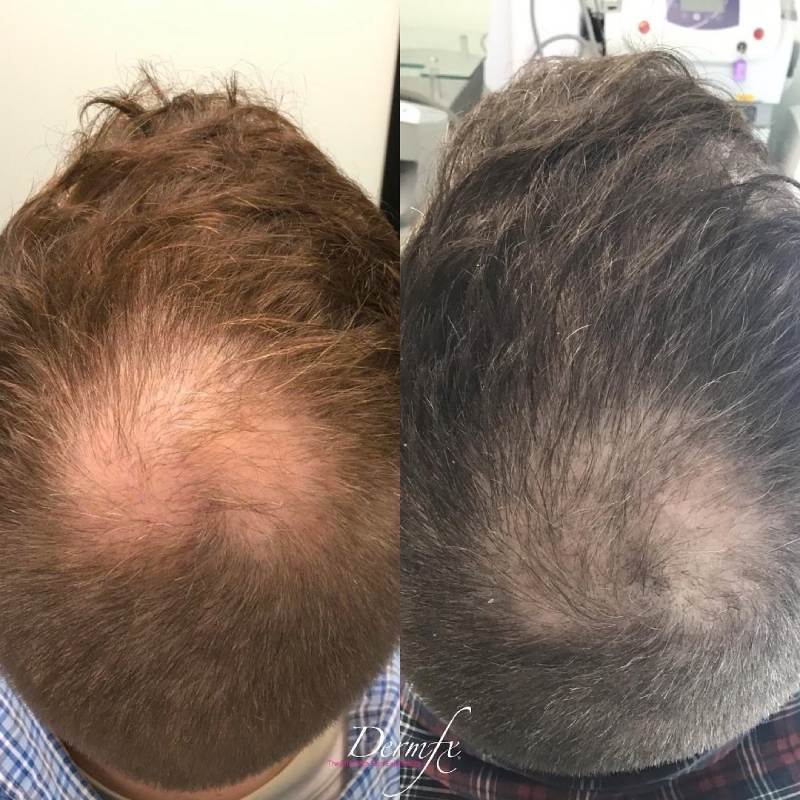 Hair Restoration