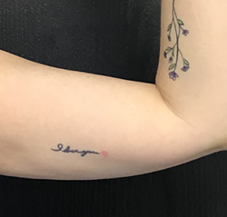 CoolSculpting Before & After Patient #2889