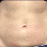 CoolSculpting Before & After Patient #2895