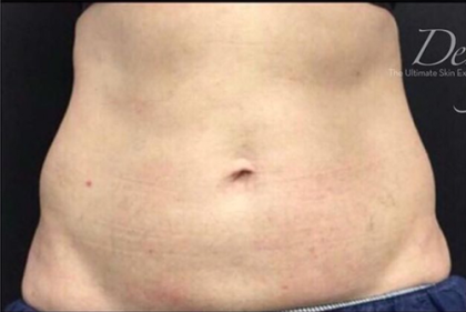 CoolSculpting Before & After Patient #2895