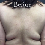CoolSculpting Before & After Patient #2893