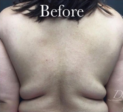 CoolSculpting Before & After Patient #2893