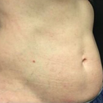 CoolSculpting Before & After Patient #2892