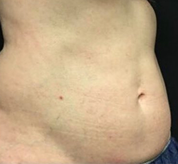 CoolSculpting Before & After Patient #2892