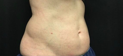 CoolSculpting Before & After Patient #2892